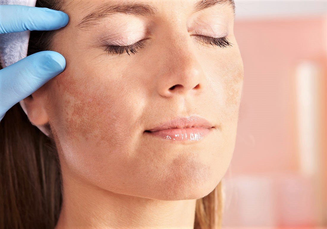 What is MELASMA?