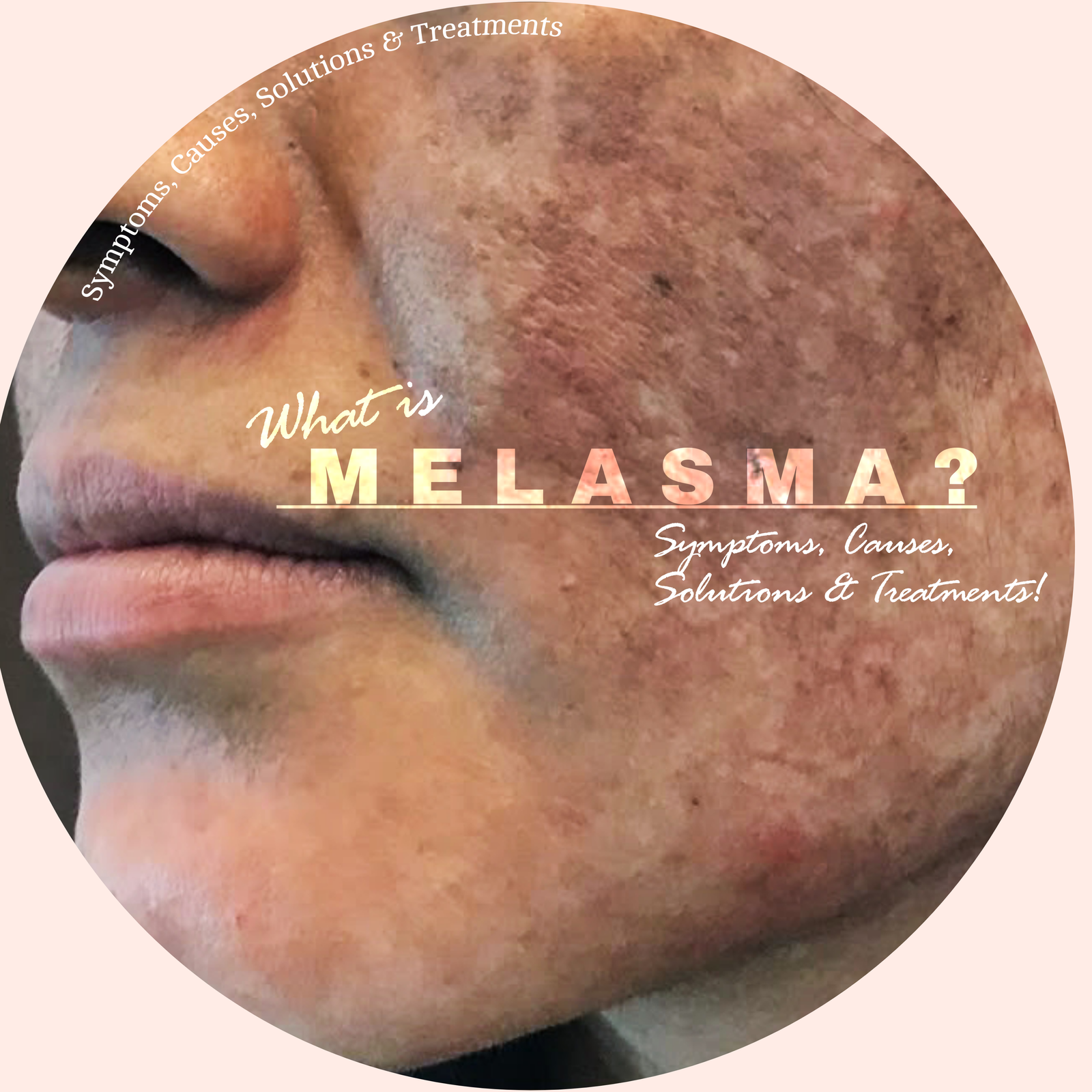 What is MELASMA?